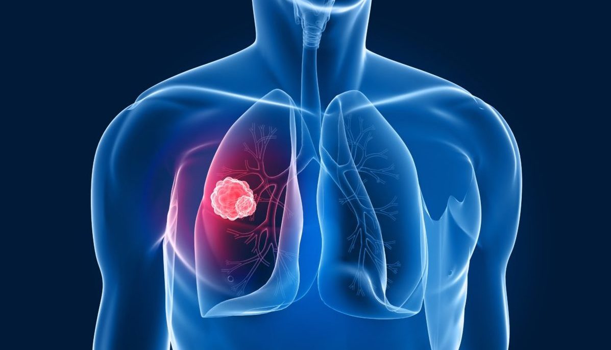 Carcinoma polmonare