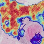 diagnosi del cancro con l’intelligenza artificiale