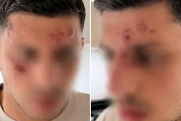 Il ragazzo ferito dopo l'aggressione a Londra perché parlava ebraico